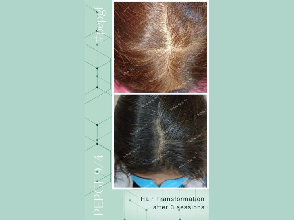 Revolutionary Hair Growth Solution PEP-GF 9/4 Developed by Dr. Ayesha Faizan at Indian Skin Clinic